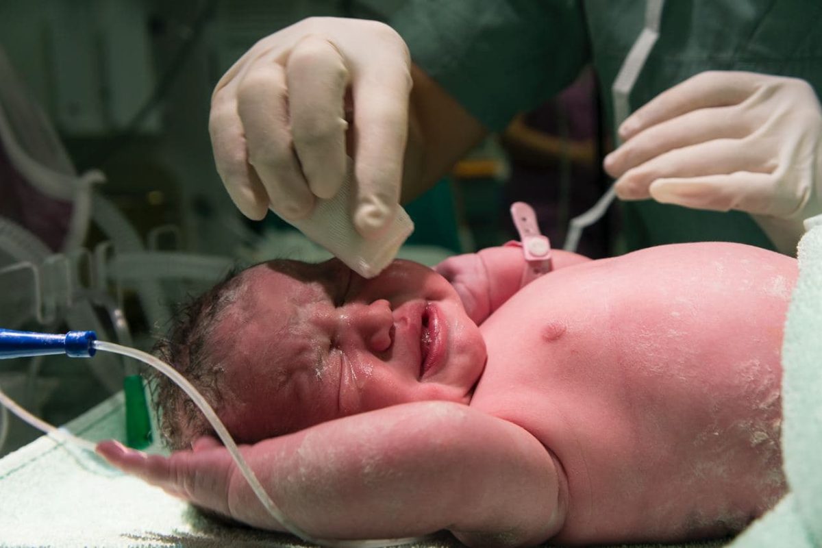Cara Mengatasi Bercak Putih Pada Wajah Bayi